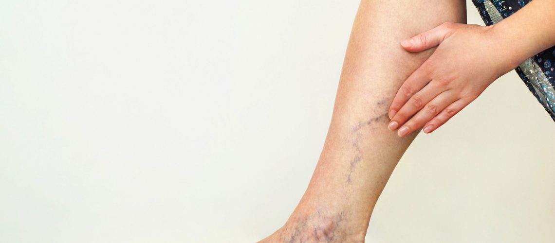 Examination of varicose veins on the womans legs