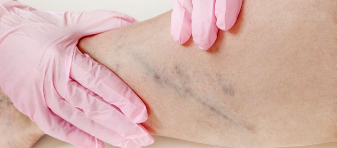 escleroterapia