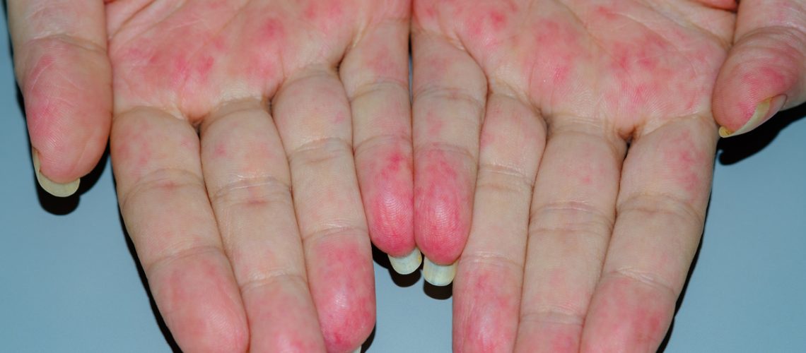 vasculite